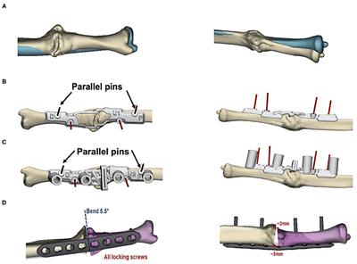 Corrective Osteotomy of Upper Extremity Malunions Using Three-Dimensional Planning and Patient-Specific Surgical Guides: Recent Advances and Perspectives